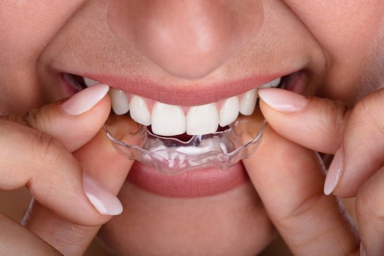 Why Invisalign in London is More Than Just Braces