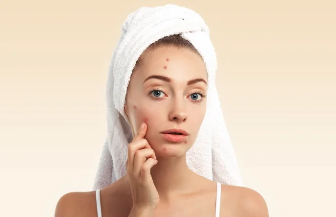 Acne Scarring